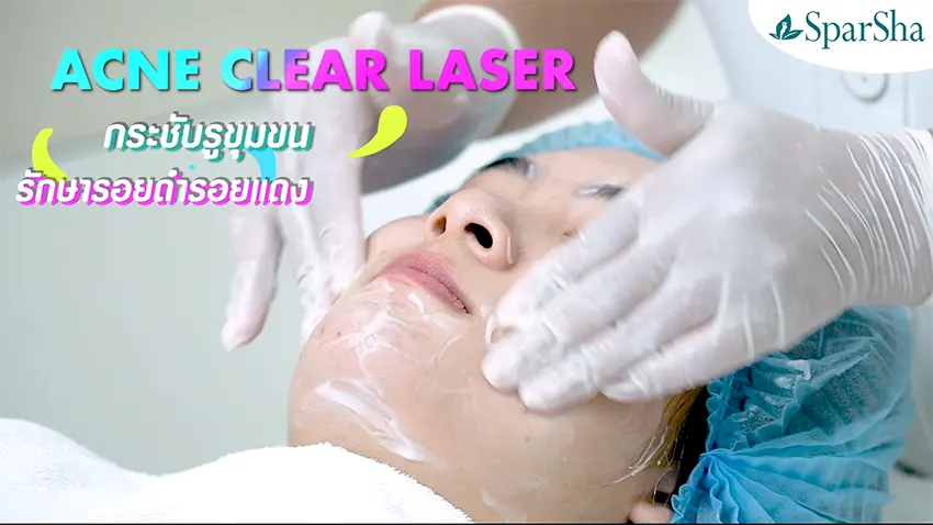ฆ่าเชื้อสิว Acne Clear Laser ปัญหาสิว เลเซอร์รักษาสิว