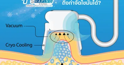 Freeze Shaping by Cool Shaping ทำไมความเย็นถึงกำจัดไขมันได้